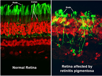 Retinitis Pigmentosa progression may be slowed by cannabis