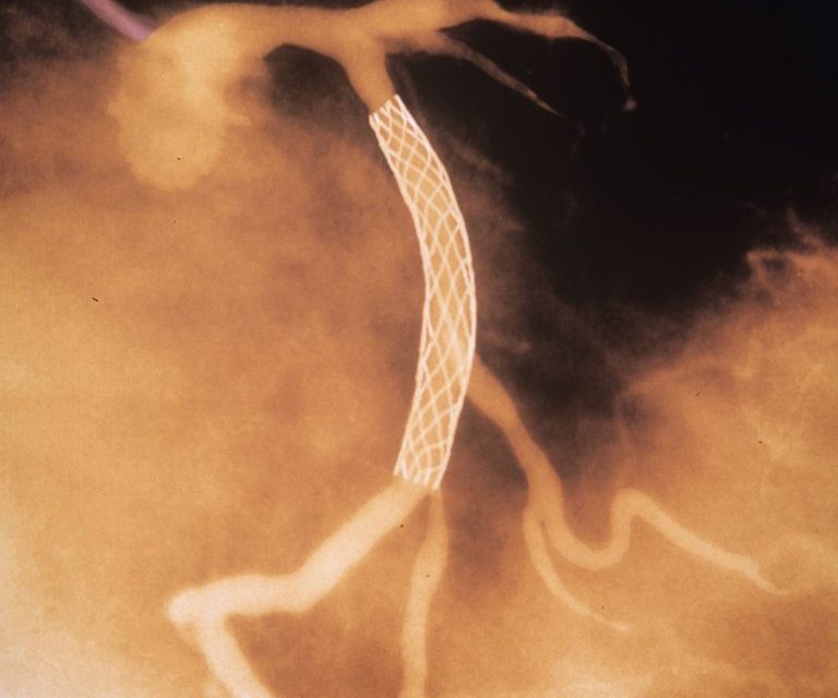 Heart Stents Don’t Ease Chest Pain (!)