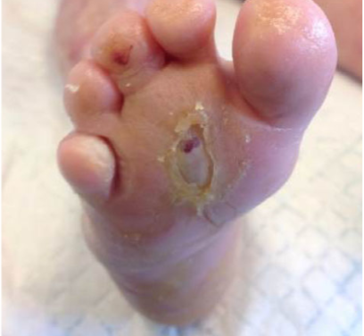 CBD effective in rare blistering condition