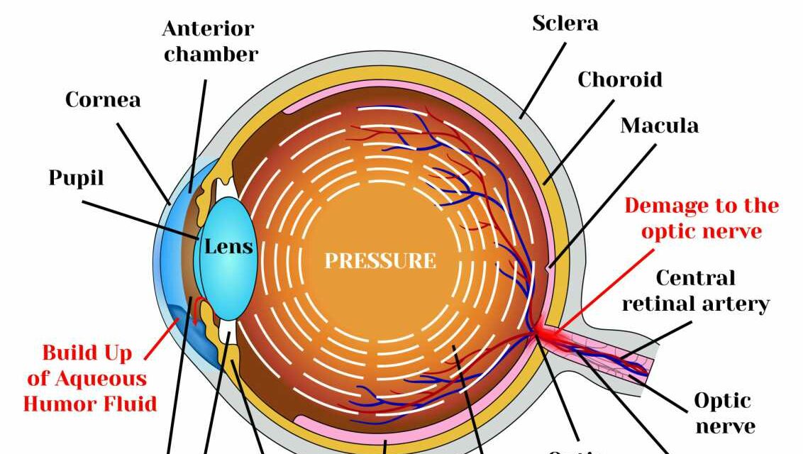 Cannabis as a treatment for Glaucoma