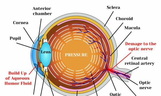 Cannabis as a treatment for Glaucoma